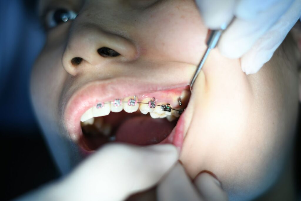 Close-up of a person's mouth with braces being examined by dental tools.