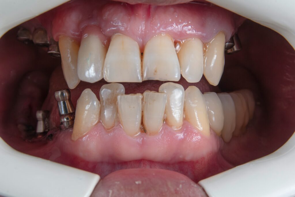 Before or during orthodontic treatment showing metal braces addressing tooth alignment and spacing issues