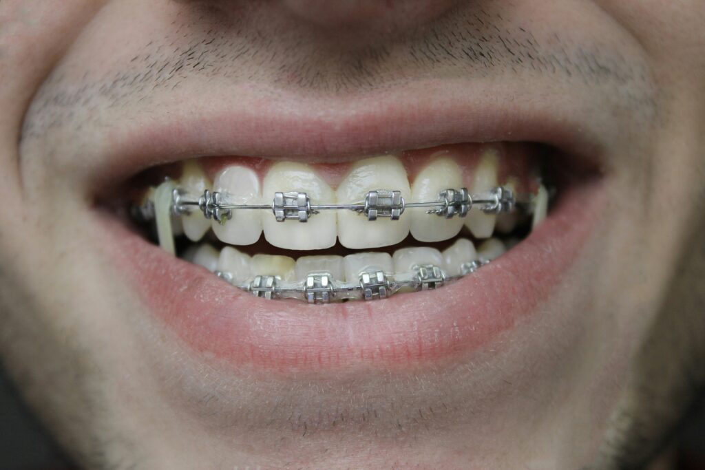 Happy orthodontic patient displaying metal braces treatment results at Bean Orthodontics in Plano, Texas