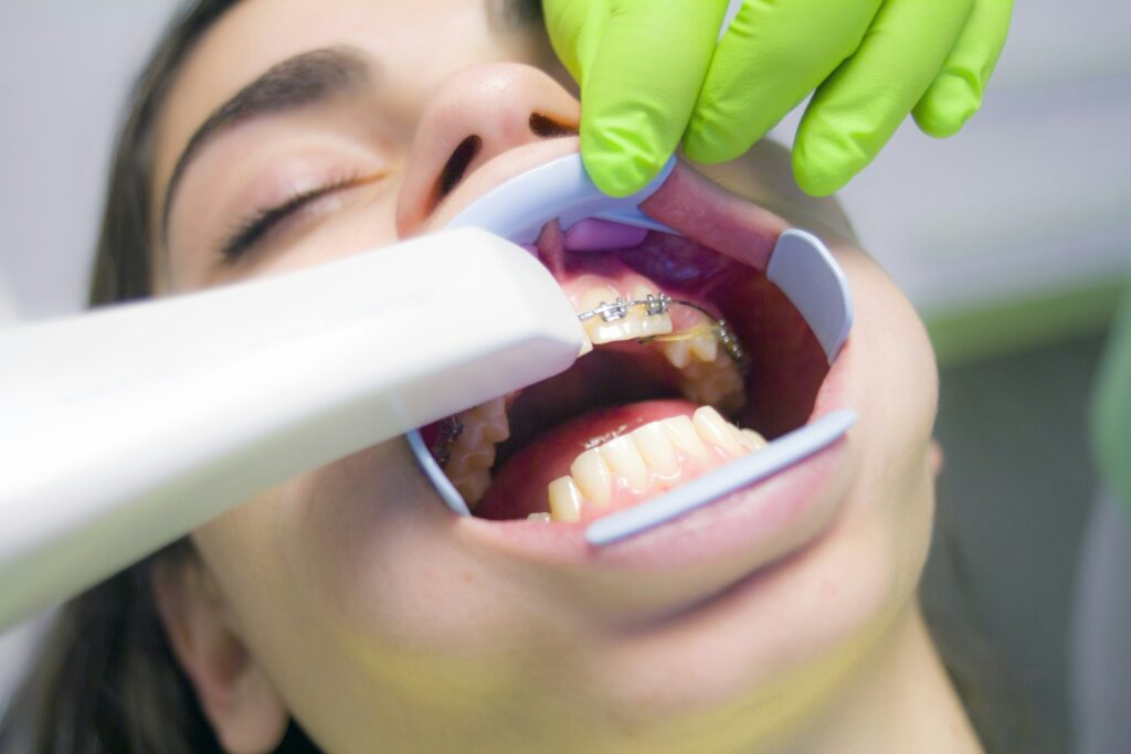 Oral hygiene maintenance for braces patient at Bean Orthodontics in Plano, Texas